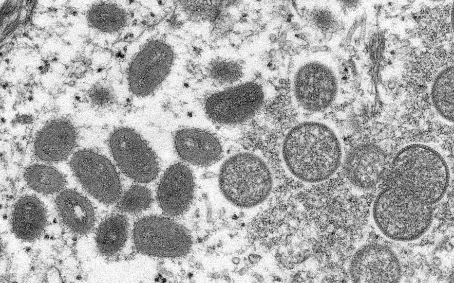  L'OMS réfléchit à "changer le nom du virus" de la variole du singe