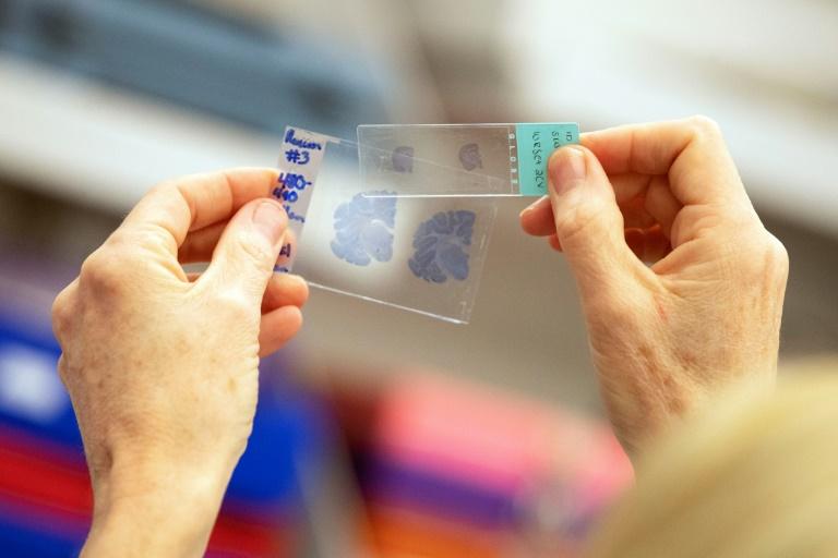 Alzheimer: Cuba annonce une nouvelle phase d'essais pour un traitement