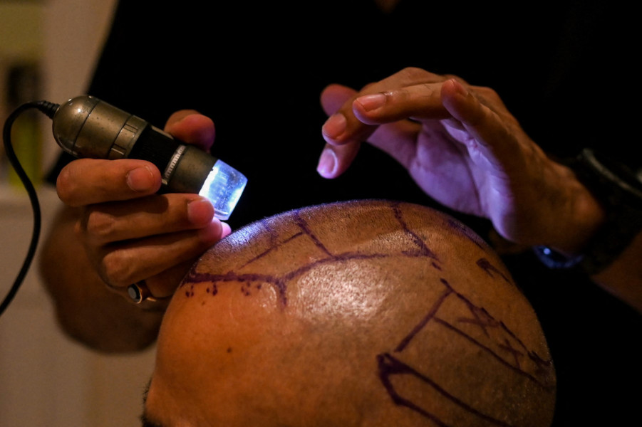 زراعة الشعر خارج الإشراف الطبي.. ممارسات تهدد صحة الزبناء