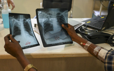 Tuberculose